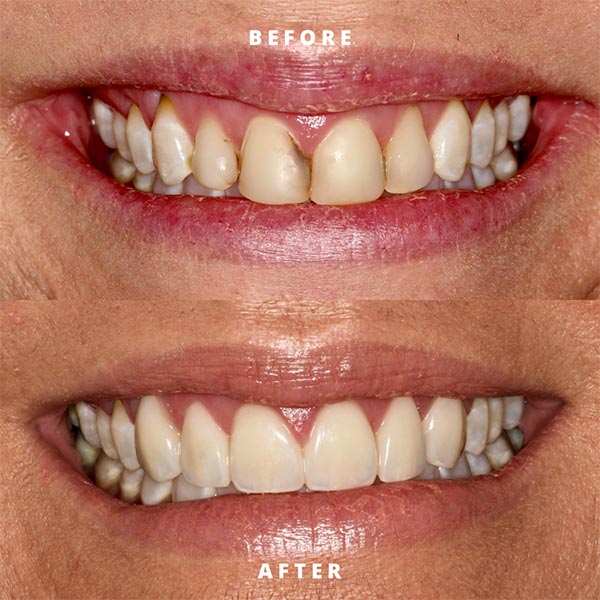 before and after of a Rosehill Dentistry patient's smile