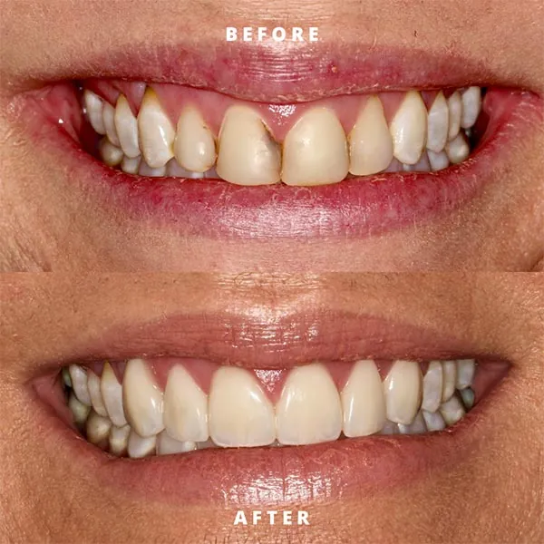 before and after of a Rosehill Dentistry patient's smile