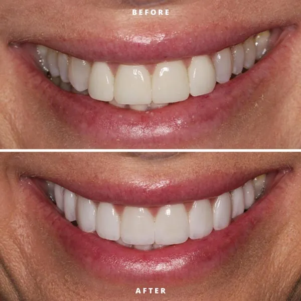 teeth whitening results from Rosehill Dentistry