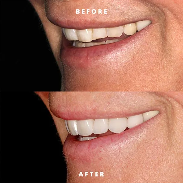 closeup showing how Rosehill Dentistry transformed a patient's smile